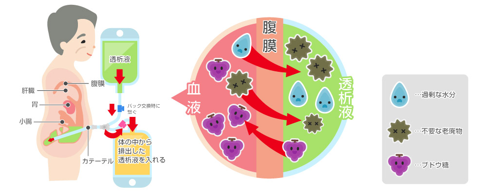 腹膜透析原理